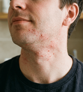 Pourquoi vous avez des boutons après rasage et comment les éviter ?